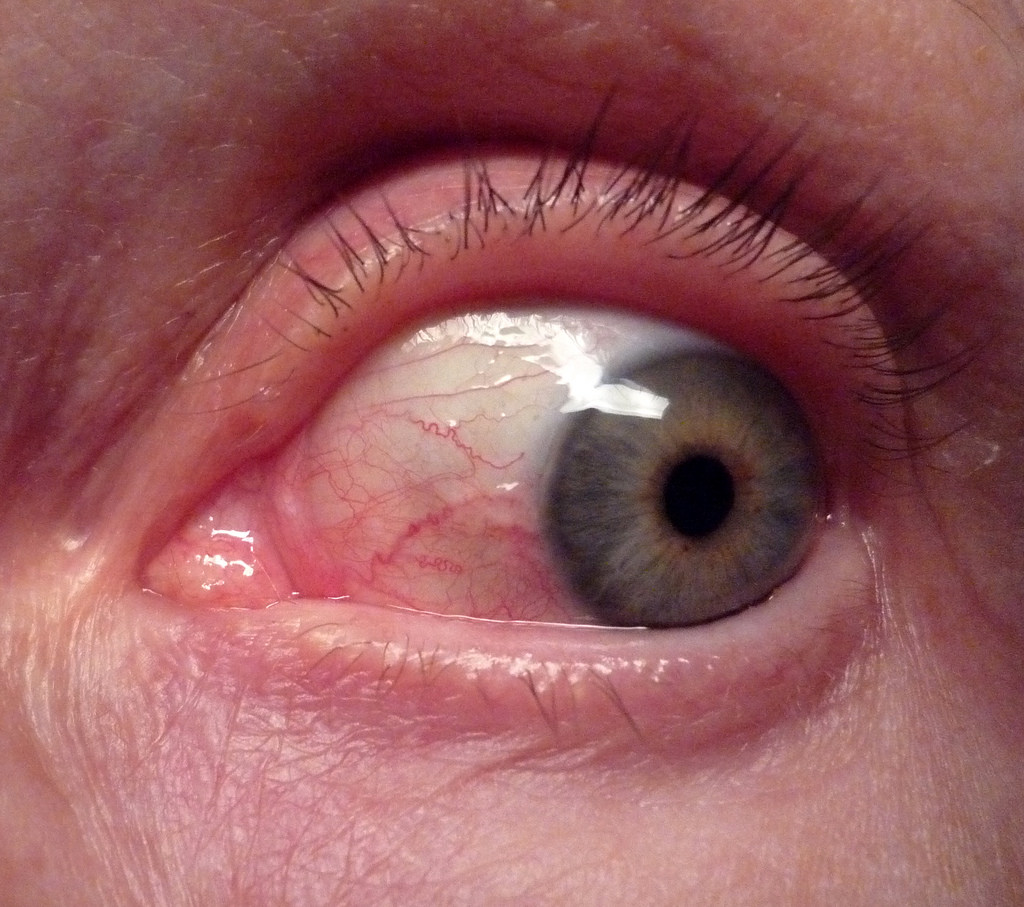 Conjunctivitis Allergic Infectious Or Chemical Www advancedoptometry