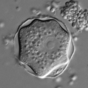 Acanthamoeba Keratitis