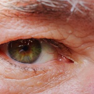 What is the most common aging eye condition?