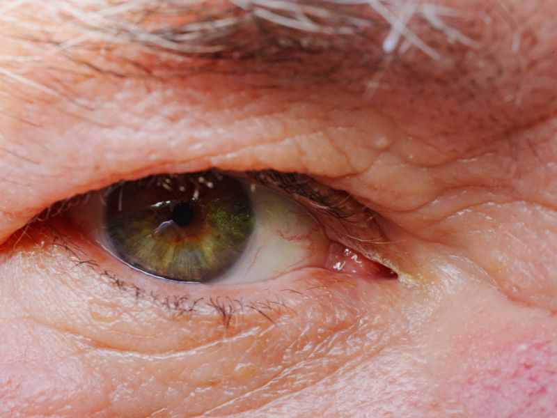 What is the most common aging eye condition?